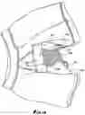 Fig. 11 - Moisture Absorbent Undergarment