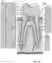 Fig. 02 - Periodontic treatment and method