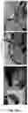 Fig. 14 - Compositions and methods for inhibiting post-surgical adhesions