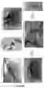 Fig. 15 - Compositions and methods for inhibiting post-surgical adhesions
