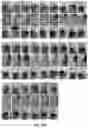 Fig. 16 - Compositions and methods for inhibiting post-surgical adhesions