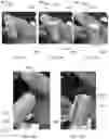 Fig. 09 - Systems and methods for removing a covering from a bodily surface
