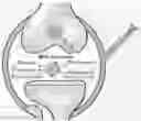 Fig. 01 - METHOD FOR TREATING OSTEOARTHRITIS WITH A COMBINATION OF MESENCHYMAL STEM CELL EXOSOMES, SYNOVIAL MESENCYMAL STEM CELLS, AND SCAFFOLDS