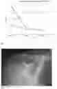 Fig. 02 - METHOD FOR TREATING OSTEOARTHRITIS WITH A COMBINATION OF MESENCHYMAL STEM CELL EXOSOMES, SYNOVIAL MESENCYMAL STEM CELLS, AND SCAFFOLDS