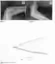 Fig. 06 - METHOD FOR TREATING OSTEOARTHRITIS WITH A COMBINATION OF MESENCHYMAL STEM CELL EXOSOMES, SYNOVIAL MESENCYMAL STEM CELLS, AND SCAFFOLDS