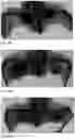 Fig. 20 - Method for preparing a bone protein preparation and a bone protein preparation