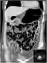 Fig. 01 - PER-ORAL NEGATIVE CONTRAST AGENT FOR ABDOMINAL IMAGING