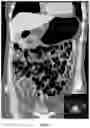 Fig. 03 - PER-ORAL NEGATIVE CONTRAST AGENT FOR ABDOMINAL IMAGING