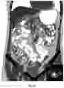 Fig. 05 - PER-ORAL NEGATIVE CONTRAST AGENT FOR ABDOMINAL IMAGING