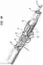 Fig. 32 - Insertion device for one-handed insertion of a guidewire into the lumen of a vessel/cavity