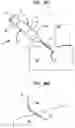 Fig. 45 - Insertion device for one-handed insertion of a guidewire into the lumen of a vessel/cavity