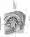 Fig. 13 - Intravaginal electrical stimulation device for treating female pelvic pain