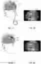 Fig. 02 - Stimulation system with monolithic-lead component connected to skull mount package