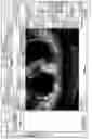 Fig. 68 - Multi-target treatment planning and delivery and virtual localization for radiation therapy