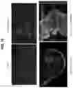 Fig. 29 - NON-HLA MATCHED HUMANIZED NSG MOUSE MODEL WITH PATIENT-DERIVED XENOGRAFT