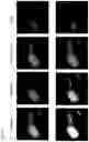 Fig. 12 - CCR5-BASED METHODS FOR PREDICTING OVERALL AND PROGRESSION FREE SURVIVAL IN SUBJECTS HAVING CANCER