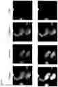 Fig. 16 - CCR5-BASED METHODS FOR PREDICTING OVERALL AND PROGRESSION FREE SURVIVAL IN SUBJECTS HAVING CANCER