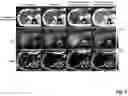 Fig. 13 - Free-breathing MRI with motion compensation