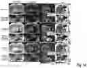Fig. 21 - Free-breathing MRI with motion compensation