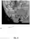 Fig. 09 - SYSTEM AND METHOD FOR TUMOR TRACKING