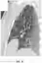 Fig. 02 - Pulmonary analysis using transpulmonary pressure