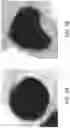 Fig. 08 - Pulmonary analysis using transpulmonary pressure
