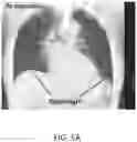 Fig. 09 - Pulmonary analysis using transpulmonary pressure