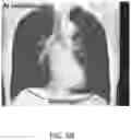 Fig. 10 - Pulmonary analysis using transpulmonary pressure