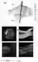Fig. 05 - Determination and visualization of damage to an anatomical joint