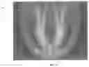 Fig. 14 - Determining rotation axis from x-ray radiographs