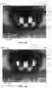 Fig. 12 - Ocular surface interferometry (OSI) for imaging, processing, and/or displaying an ocular tear film