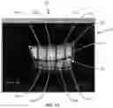 Fig. 13 - Ocular surface interferometry (OSI) for imaging, processing, and/or displaying an ocular tear film
