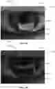 Fig. 14 - Ocular surface interferometry (OSI) for imaging, processing, and/or displaying an ocular tear film