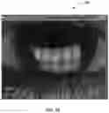 Fig. 27 - Ocular surface interferometry (OSI) for imaging, processing, and/or displaying an ocular tear film