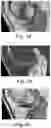 Fig. 03 - METHOD AND SYSTEM FOR VISUALIZING A PROPERTY OF CARTILAGE
