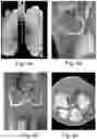 Fig. 05 - METHOD AND SYSTEM FOR VISUALIZING A PROPERTY OF CARTILAGE
