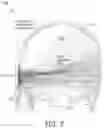Fig. 08 - Adaptive pulsing for sonothrombolysis treatment