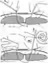 Fig. 28 - Systems, devices, and methods for closing an abdominal wall defect