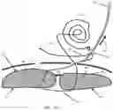 Fig. 29 - Systems, devices, and methods for closing an abdominal wall defect