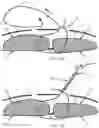 Fig. 30 - Systems, devices, and methods for closing an abdominal wall defect
