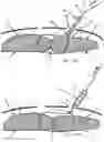 Fig. 31 - Systems, devices, and methods for closing an abdominal wall defect