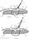Fig. 36 - Systems, devices, and methods for closing an abdominal wall defect