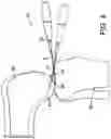 Fig. 04 - Force measuring joint distraction lever