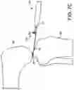 Fig. 08 - Force measuring joint distraction lever