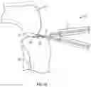 Fig. 11 - Force measuring joint distraction lever