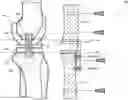 Fig. 01 - System for total knee replacement