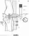 Fig. 05 - System for total knee replacement