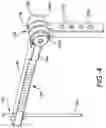 Fig. 08 - Chevron osteotomy tools and methods