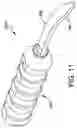Fig. 15 - Chevron osteotomy tools and methods