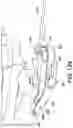Fig. 17 - Chevron osteotomy tools and methods